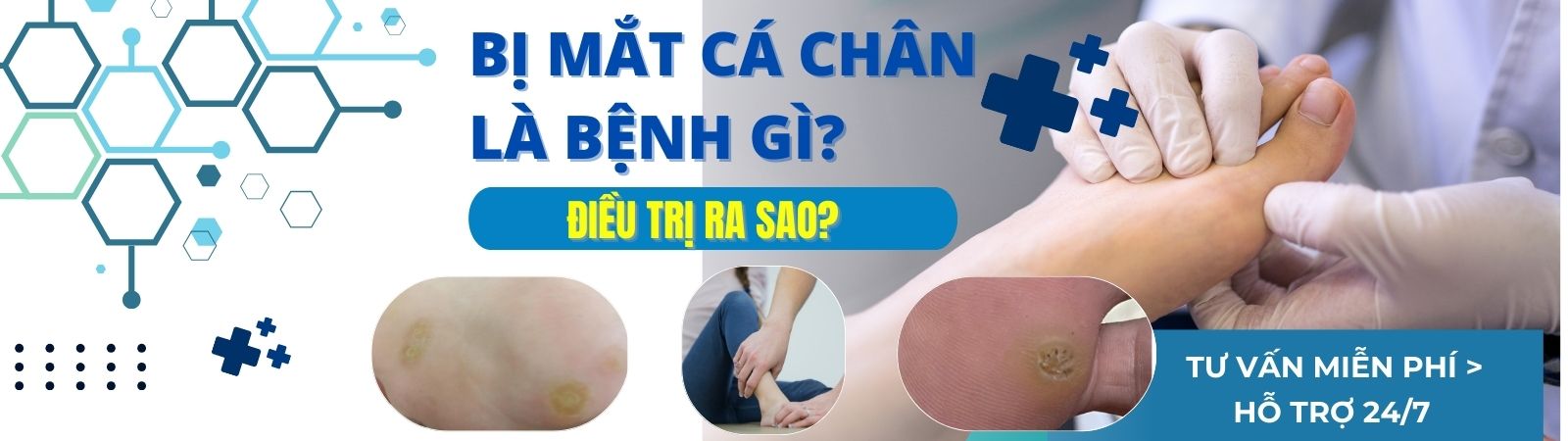 BỊ MẮT CÁ CHÂN LÀ BỆNH GÌ? ĐIỀU TRỊ RA SAO?